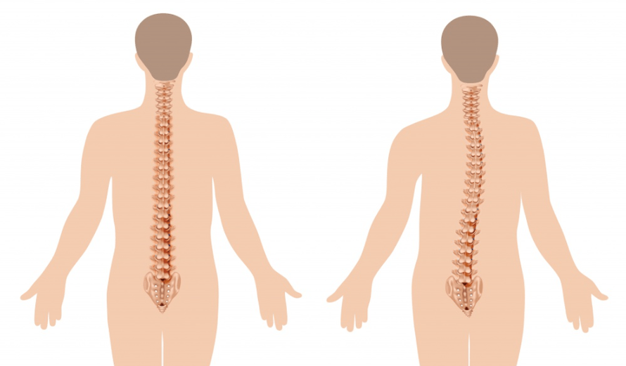 az osteochondrosis megnyilvánulása