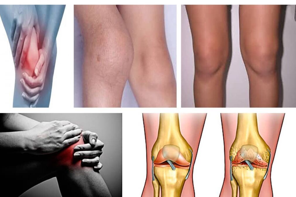 Arthrosis mi az